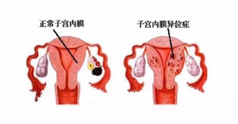 子宫内膜异位可以去福建医科大学附属第一医院做试管吗