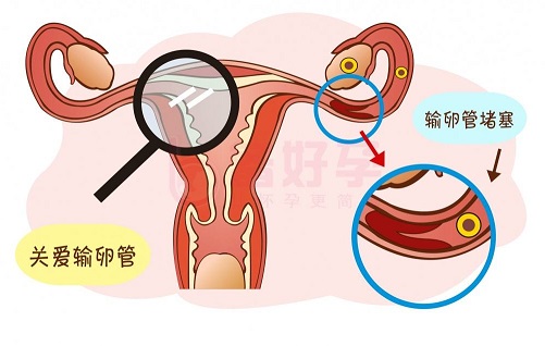 输卵管堵塞能做试管