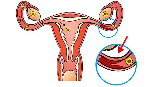 输卵管堵塞