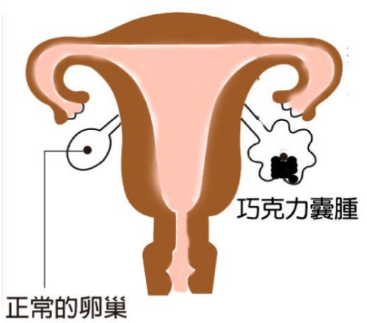 巧克力囊肿影响怀孕吗？