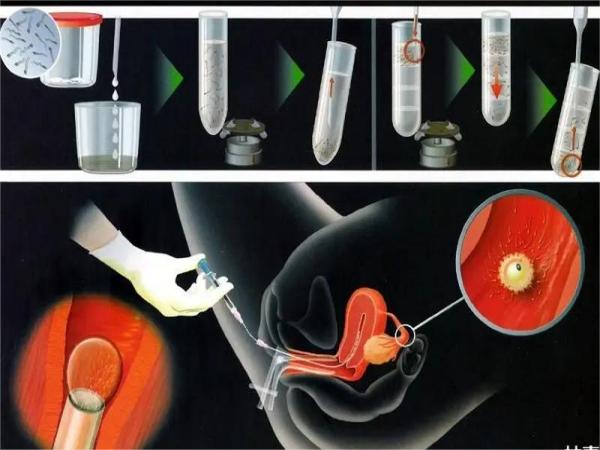 在正规三甲医院的供精人工授精一个过程是怎么样的？