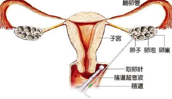 试管取卵后有无腹水自己怎么判断？