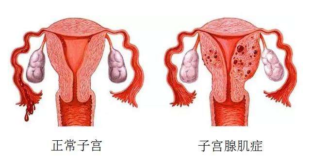 35岁子宫腺肌症可以去宁波市第一医院做试管吗？