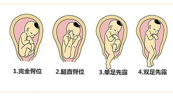 臀位快生了跟正常的一样