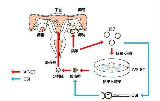 什么是体外受精？成功率高吗？