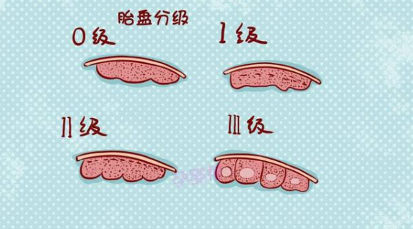 孕23周胎盘成熟1级什么意思？