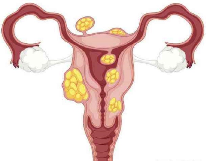切除子宫肌瘤会影响怀孕吗