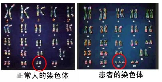 22号染色体异常还能怀孕生下健康孩子吗？