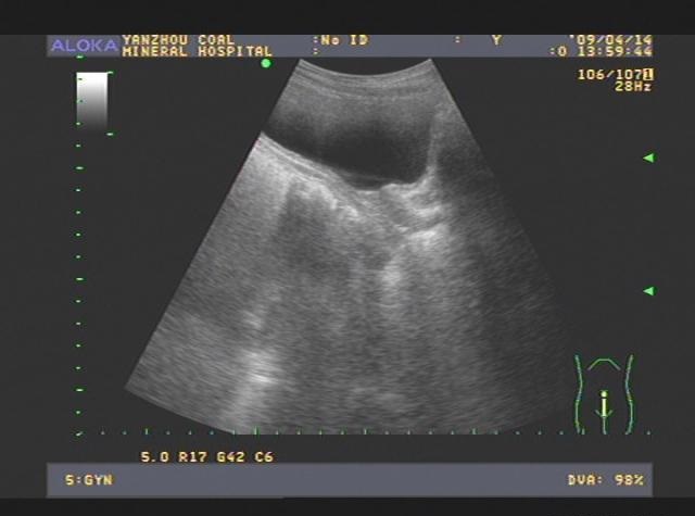 始基子宫只有1cm，可以怀孕吗？