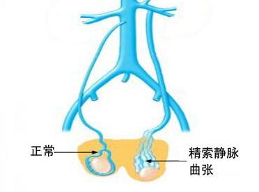 精索静脉曲张手术后多久可以同房？