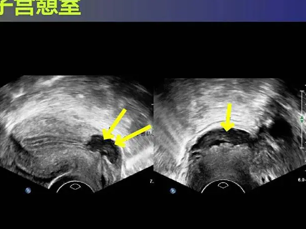 子宫憩室10mm&times;6mm怀孕了可以撑到生吗？