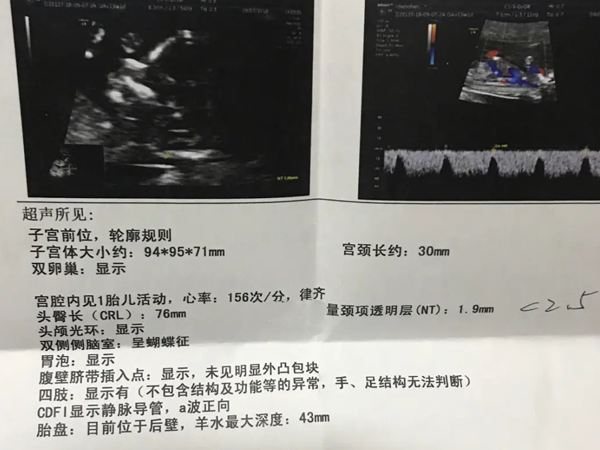 nt检查报告上显示颈部皮肤厚度1.9mm是正常的吗？